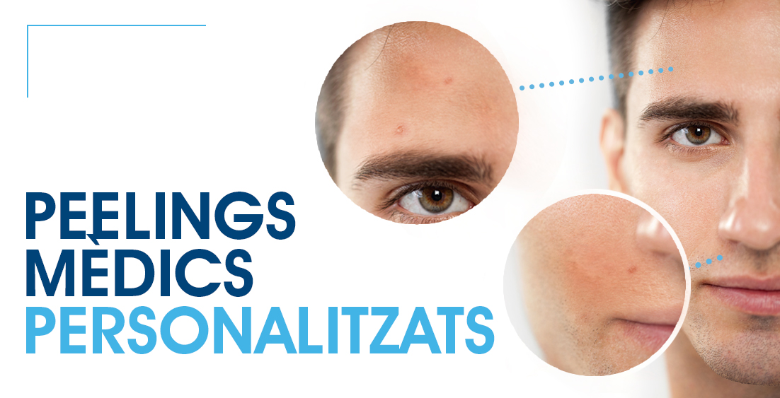 peelings mèdics 