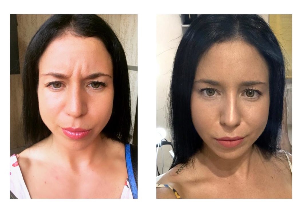 botox linies d'expressió