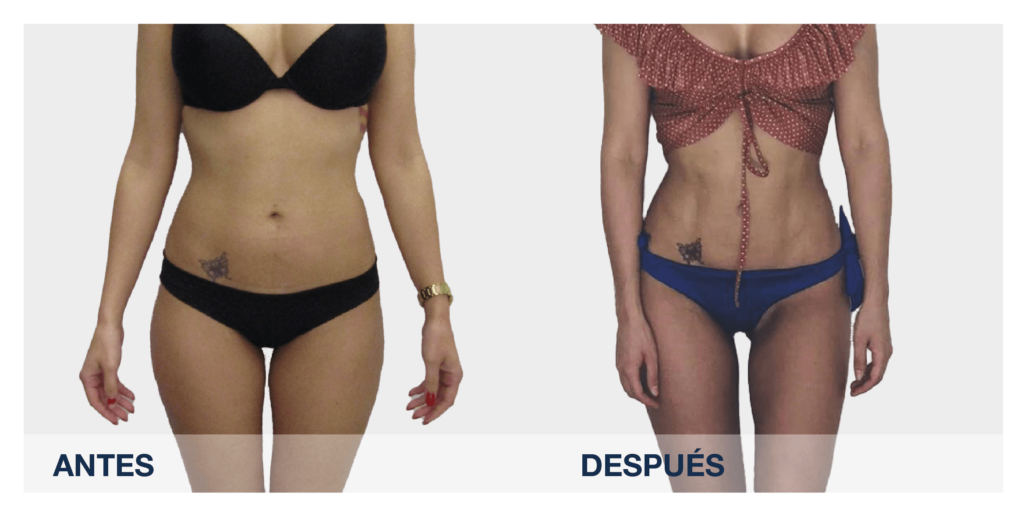 lipo vaser